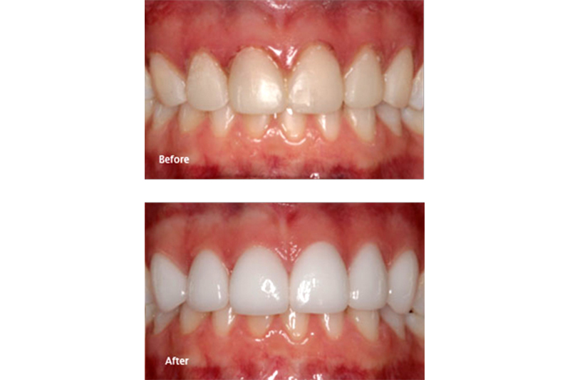 Porcelain Veneers in Ridgeland