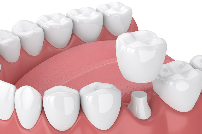 Dental Crowns in Ridgeland