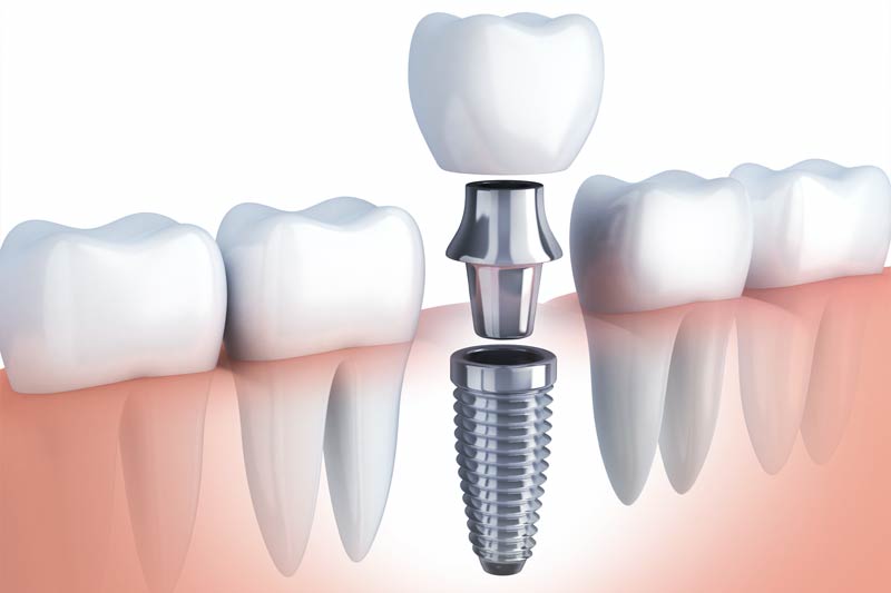 Implants Dentist in Ridgeland
